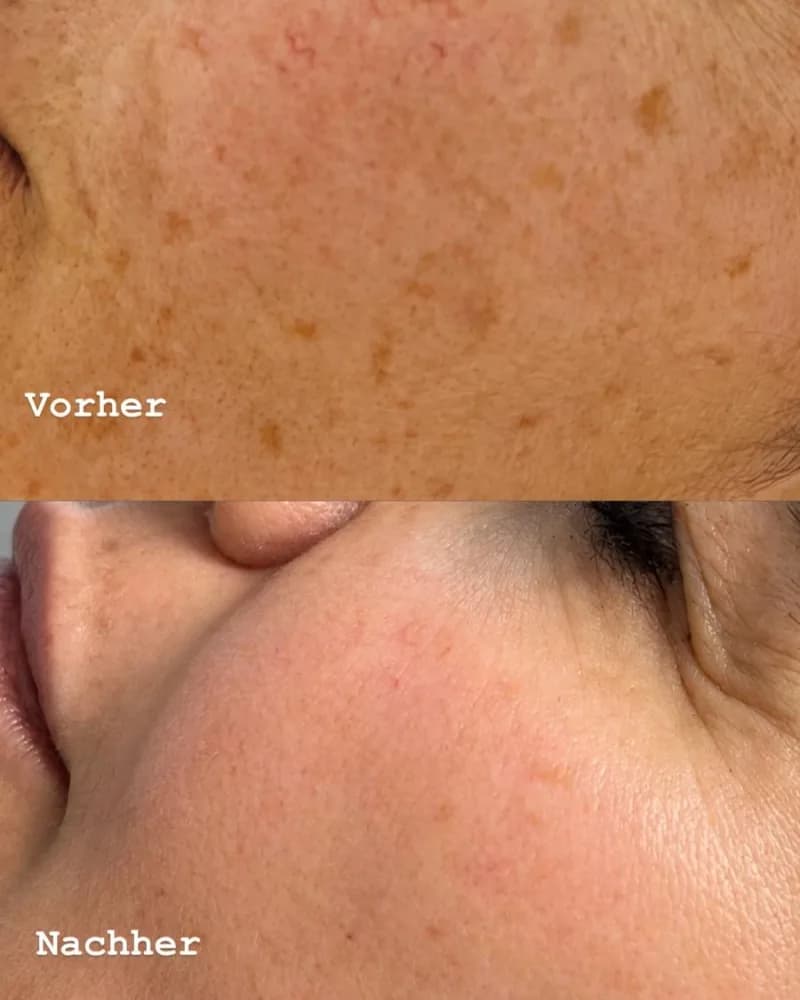 Vorher-Nachher-Vergleich: Carbon Peeling