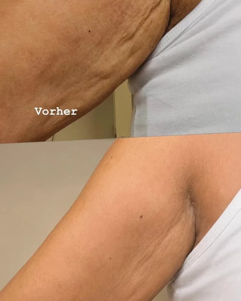 Vorher-Nachher-Vergleich: Plasma Pen