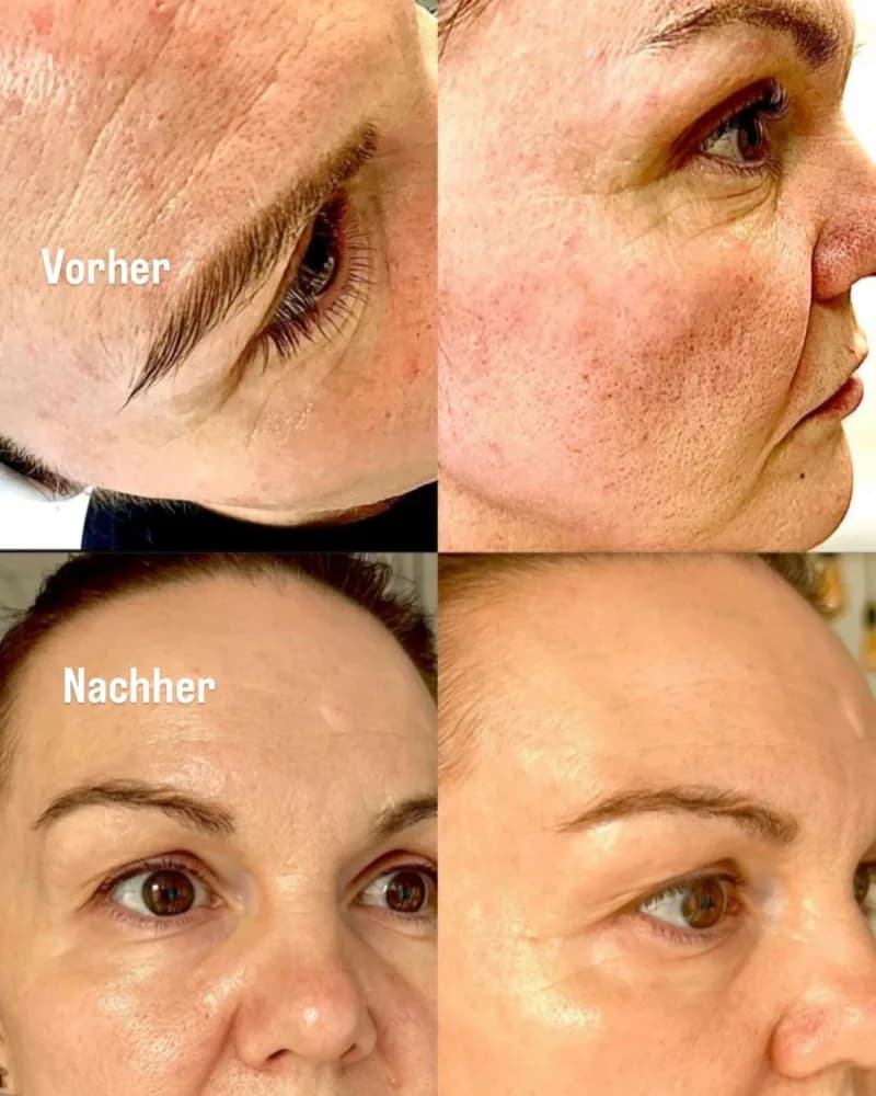 Vorher-Nachher-Vergleich: RF-Microneedling